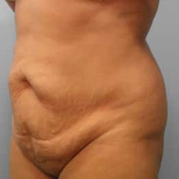 Before Image: Abdominoplasty & Lipo – Dr. Tucker - left-front-oblique