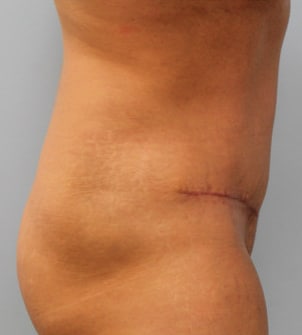 After Image: Abdominoplasty & Lipo – Dr. Tucker - right-side