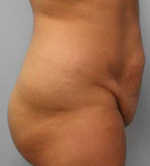 Before Image: Abdominoplasty & Lipo – Dr. Tucker - right-side