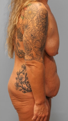 Before Image: Mommy Makeover – Dr. Tucker - right-side