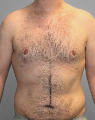 After Image: Gynecomastia- Dr. Tucker - front
