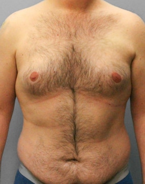 Before Image: Gynecomastia- Dr. Tucker - front
