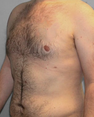 After Image: Gynecomastia- Dr. Tucker - left-front-oblique