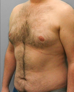 Before Image: Gynecomastia- Dr. Tucker - left-front-oblique