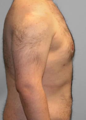 After Image: Gynecomastia- Dr. Tucker - right-side