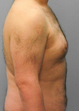 Before Image: Gynecomastia- Dr. Tucker - right-side
