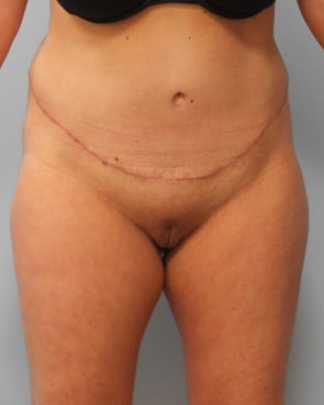 After Image: Abdominoplasty & Lipo – Dr. Tucker - front