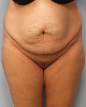 Before Image: Abdominoplasty & Lipo – Dr. Tucker - front