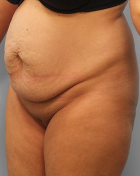 Before Image: Abdominoplasty & Lipo – Dr. Tucker - left-front-oblique