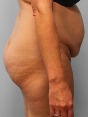 Before Image: Abdominoplasty & Lipo – Dr. Tucker - right-side