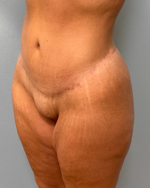 After Image: Mommy Makeover- Dr. Tucker - left-front-oblique