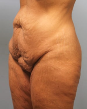 Before Image: Mommy Makeover- Dr. Tucker - left-front-oblique