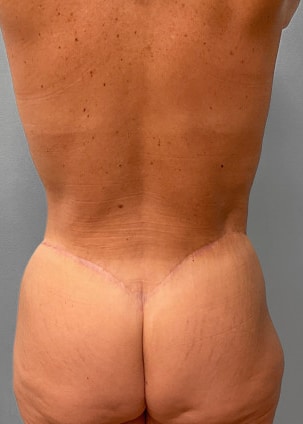 After Image: Mommy Makeover- Dr. Tucker - back