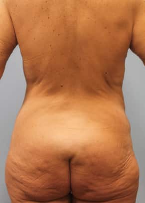 Before Image: Mommy Makeover- Dr. Tucker - back