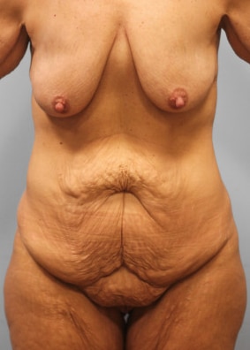 Before Image: Mommy Makeover- Dr. Tucker - front