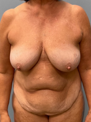 Before Image: Abdominoplasty & Breast Lift – Dr. Tucker - front