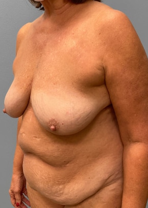 Before Image: Abdominoplasty & Breast Lift – Dr. Tucker - left-front-oblique
