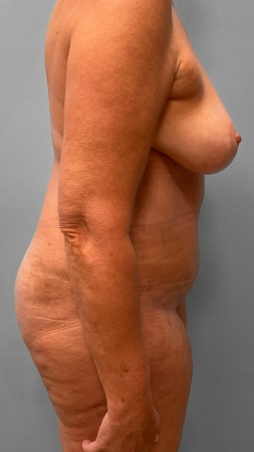 After Image: Abdominoplasty & Breast Lift – Dr. Tucker - right-side