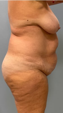 Before Image: Abdominoplasty & Breast Lift – Dr. Tucker - right-side