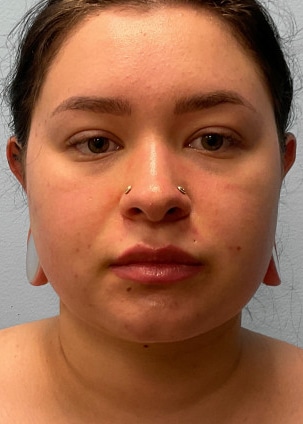 After Image: Neck Lipo- Dr. Tucker - front