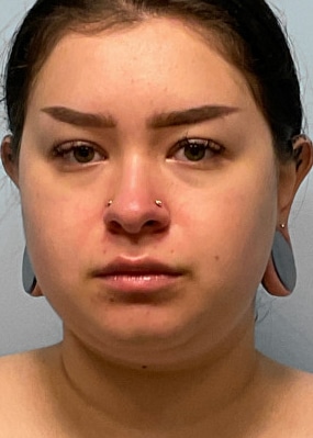 Before Image: Neck Lipo- Dr. Tucker - front