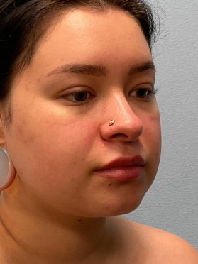 After Image: Neck Lipo- Dr. Tucker - right-front-oblique