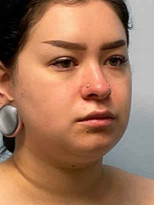 Before Image: Neck Lipo- Dr. Tucker - right-front-oblique