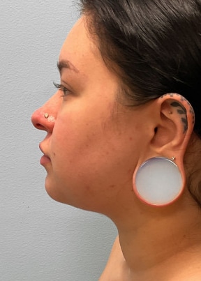 After Image: Neck Lipo- Dr. Tucker - front