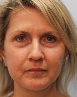 After Image: Facelift & Laser – Dr. Tucker - front