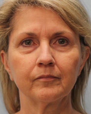 Before Image: Facelift & Laser – Dr. Tucker - front