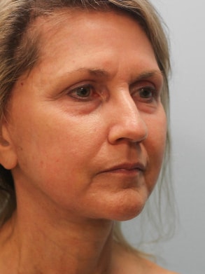 After Image: Facelift & Laser – Dr. Tucker - right-front-oblique