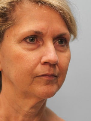 Before Image: Facelift & Laser – Dr. Tucker - right-front-oblique