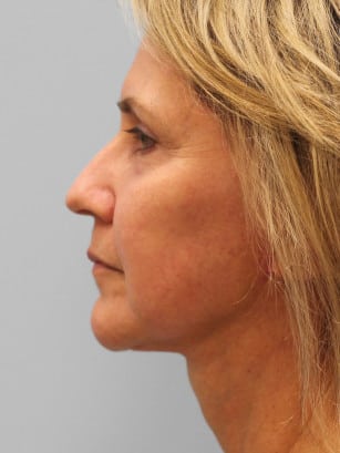 After Image: Facelift & Laser – Dr. Tucker - left-side