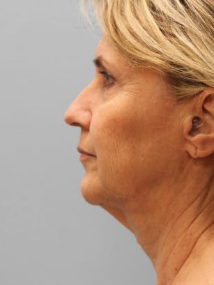 Before Image: Facelift & Laser – Dr. Tucker - left-side