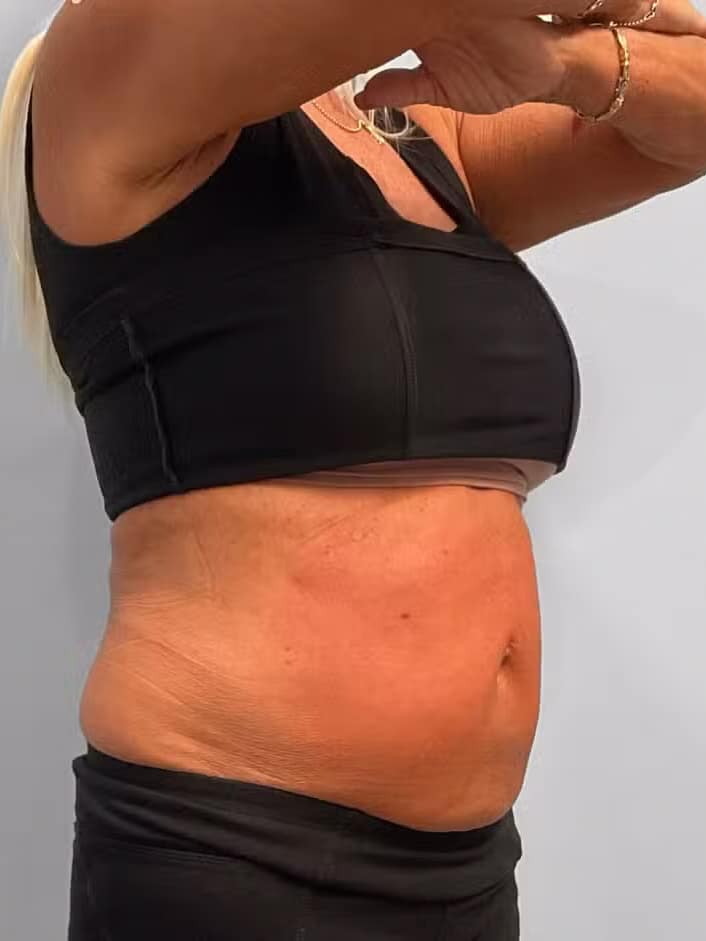 After Image: Emsculpt Neo – Jessica - right-front-oblique