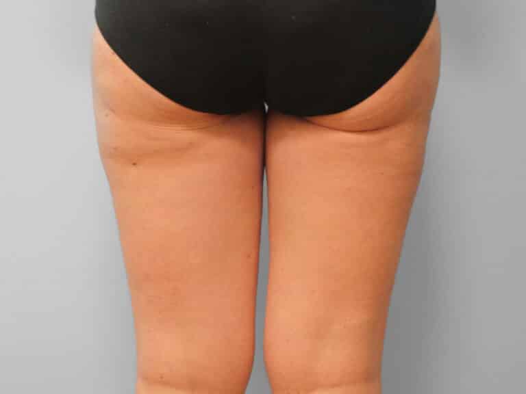 After Image: Mommy Makeover – Dr. Tucker - back