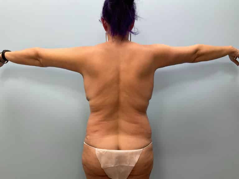 After Image: Mommy Makeover – Dr. Tucker - back