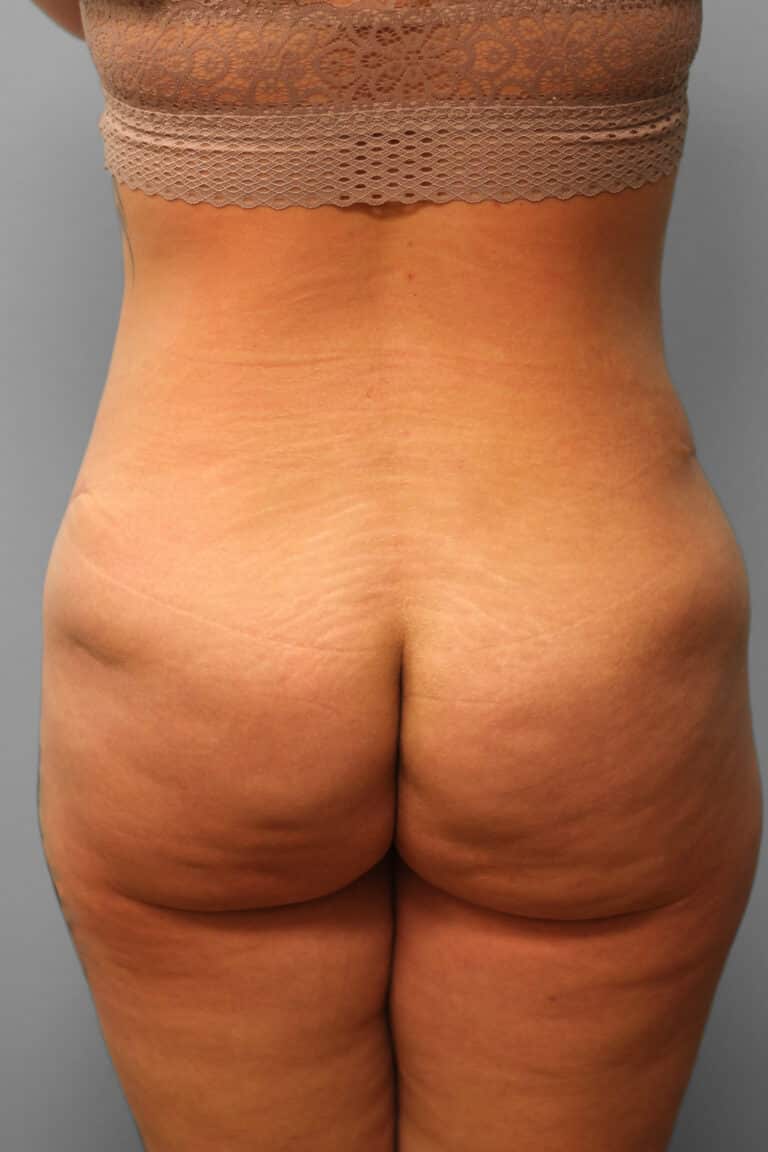After Image: Abdominoplasty – Dr. Howell - back