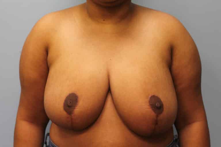 After Image: Breast Reduction – Dr. Howell - front