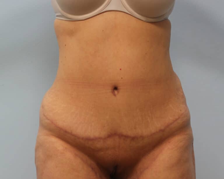 After Image: Abdominoplasty – Dr. Tucker - front