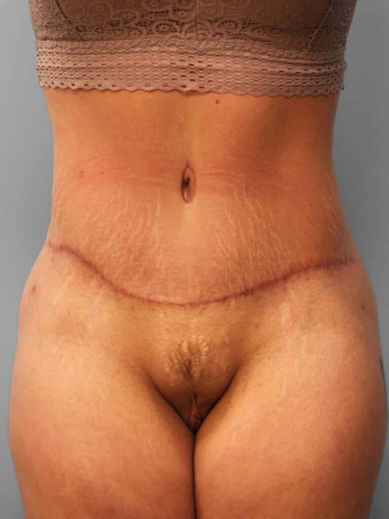 After Image: Abdominoplasty – Dr. Howell - front
