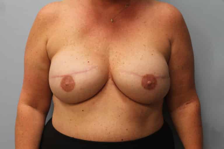 After Image: Breast Reconstruction-Dr.Tucker - front