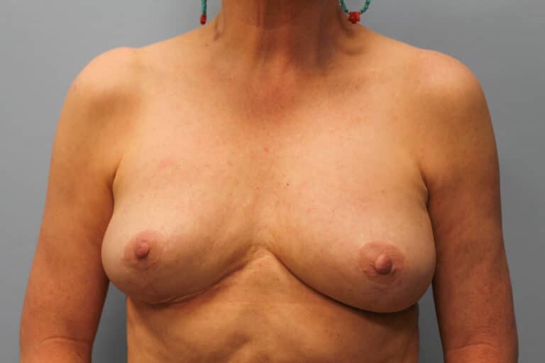 After Image: Breast Implant Revision- Dr. Howell - front
