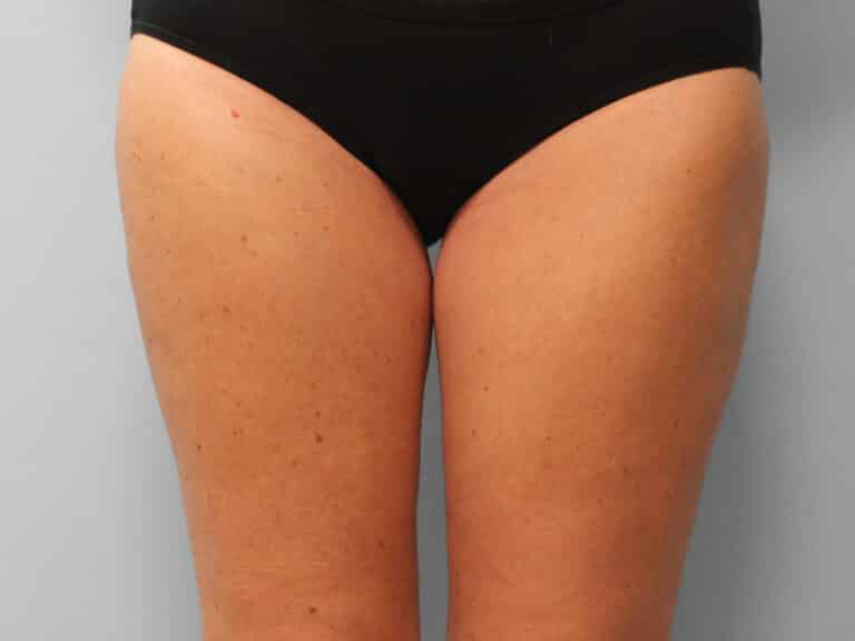 After Image: Mommy Makeover – Dr. Tucker - front