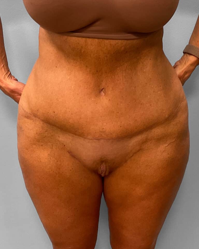 After Image: Abdominoplasty & Thigh Lift – Dr. Tucker - front