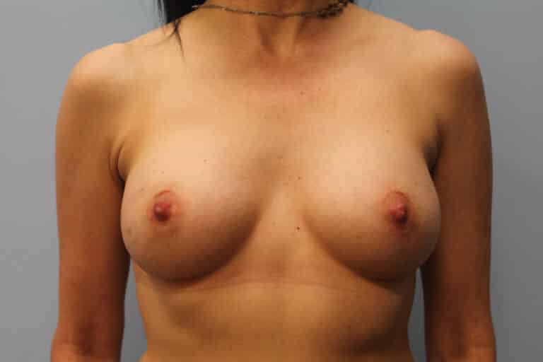 After Image: Breast Augmentation-Dr. Howell - front