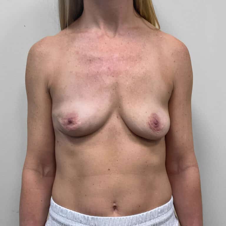 After Image: Breast Implant Removal- Dr. Tucker - front