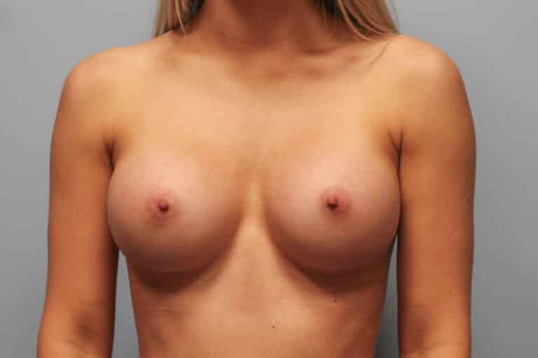 After Image: Breast Augmentation- Dr. Howell - front