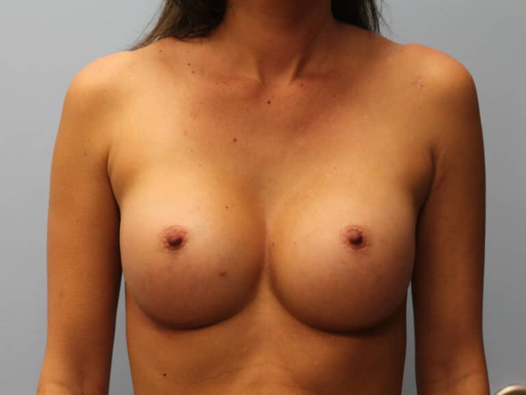 After Image: Breast Augmentation – Dr. Tucker - front