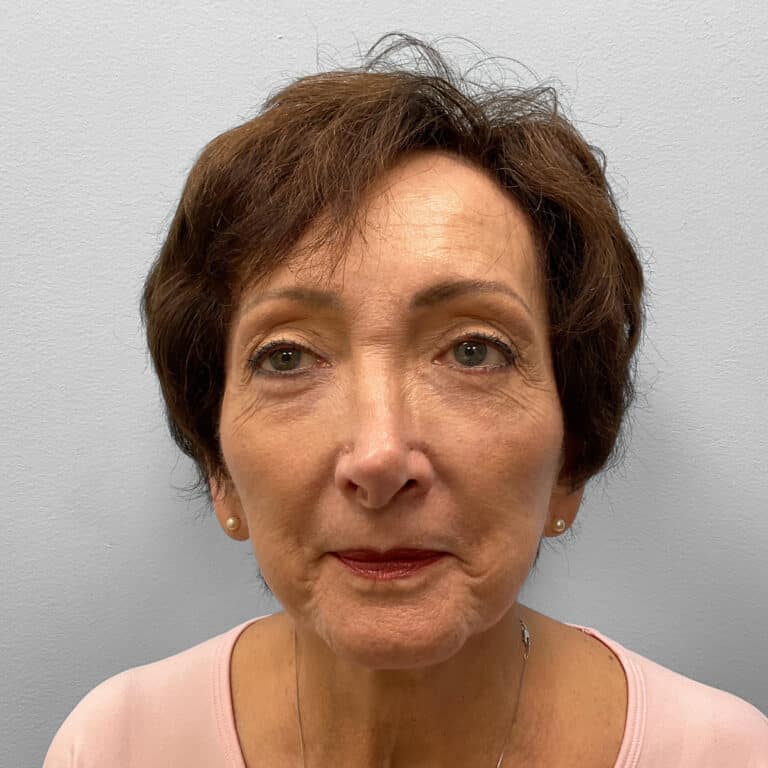After Image: Blepharoplasty – Dr. Tucker - front